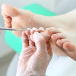 Orthonyxia in Mollet del Vallés: Painless and Non-Surgical Solution for Ingrown and Curved Toenails | IBC Comprés Podiatry
